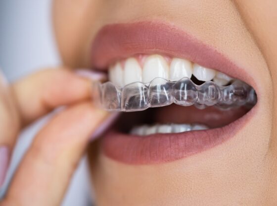 Clear aligners (invisalign)